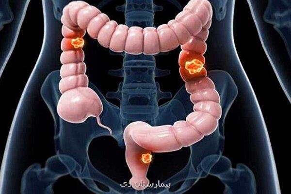 افزایش بقا در سرطان پیشرفته روده بزرگ با درمان ترکیبی